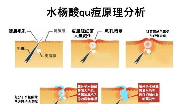 CF雷神刷酸步骤是什么？刷酸过程中应注意什么？